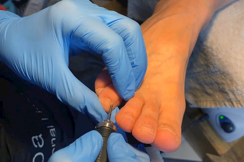 Pedikérka odstraňuje kůžičku na noze frézou